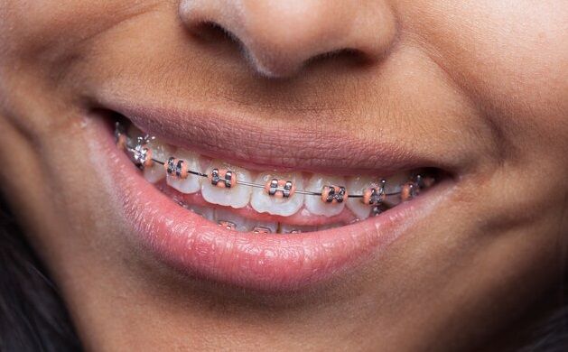 Get Dental Braces – Achieve a Perfect Smile Today!, Port Harcourt, Rivers
