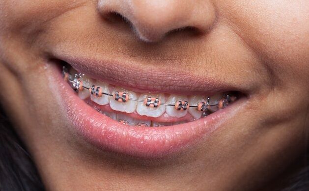 Dental Braces Treatment, Port Harcourt, Rivers, Health and Beauty Services