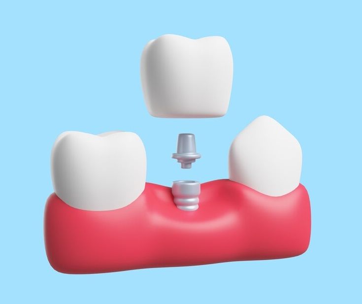 Dental Implants, Services