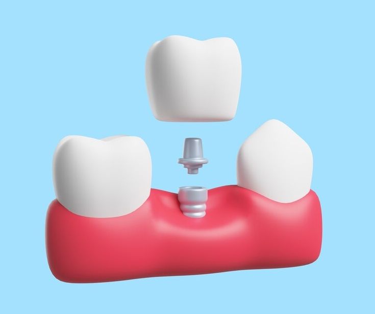 Dental Implants, Port Harcourt, Rivers - Available in Nigeria