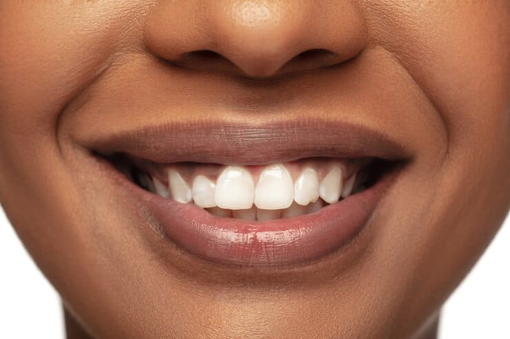 Dental Veneers, Port Harcourt, Rivers - Image 1