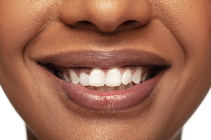 Dental Veneers, Port Harcourt, Rivers - Image 1